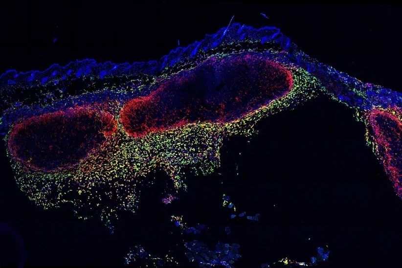 melanoma research